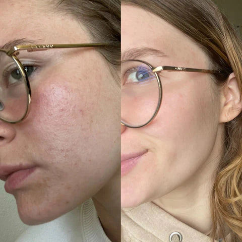 Before and after skin comparison